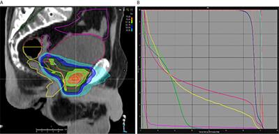 Salvage Radiotherapy for Macroscopic Local Recurrence Following Radical Prostatectomy